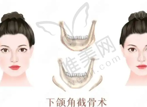 广州注射隆鼻医院面诊考察建议