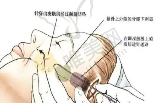 上海高冠云双眼皮修复避坑指南