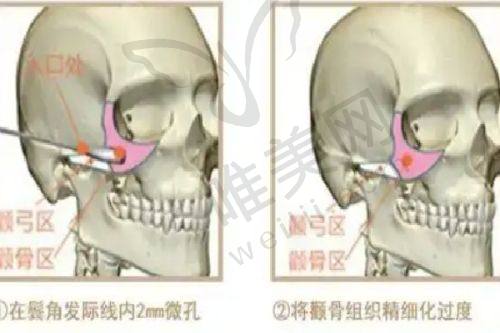 上海高冠云双眼皮修复费用分析