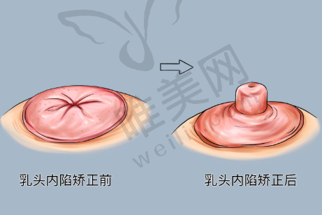 不同鼻型选西安注射隆鼻医生建议