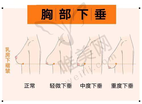 上海高冠云双眼皮修复总结建议