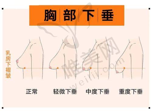 西安注射隆鼻避坑教训