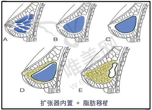 上海愉悦美联臣医疗美容医院 - 上海缩胸手术综合实力医院