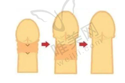 北京法令纹好的医院挑选方法