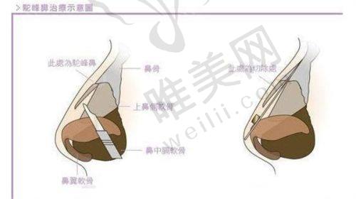 北京内窥镜除皱价格一览表及避坑指南