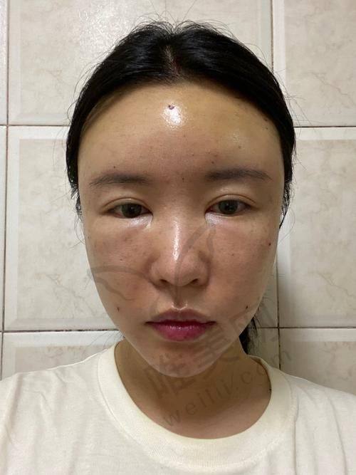2025年广州华美脂肪填充医生名单及技术