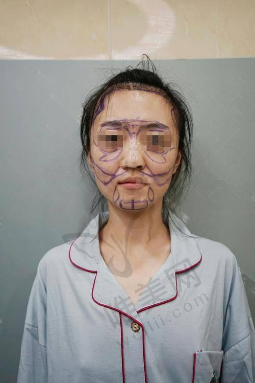 广州华美脂肪填充的优势