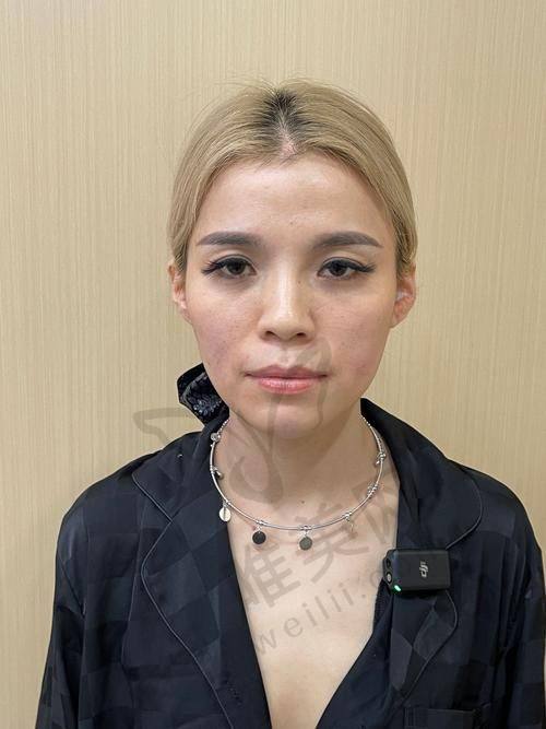 注射大佬黄剑美和谢雯谁更厉害