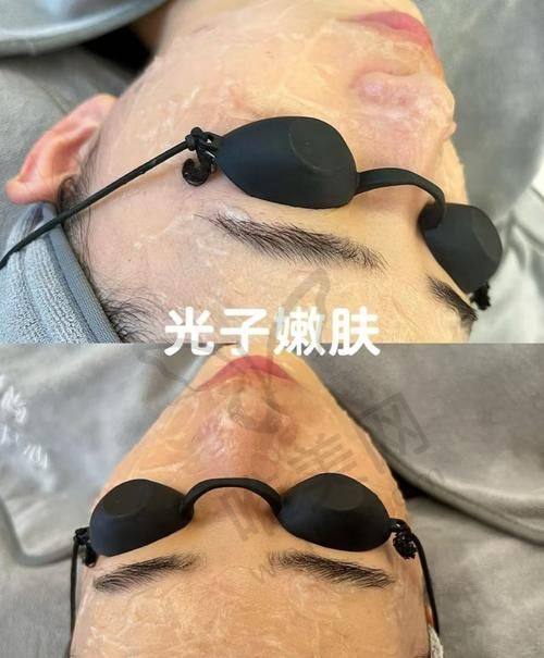 2025宁波光子嫩肤价格大公开