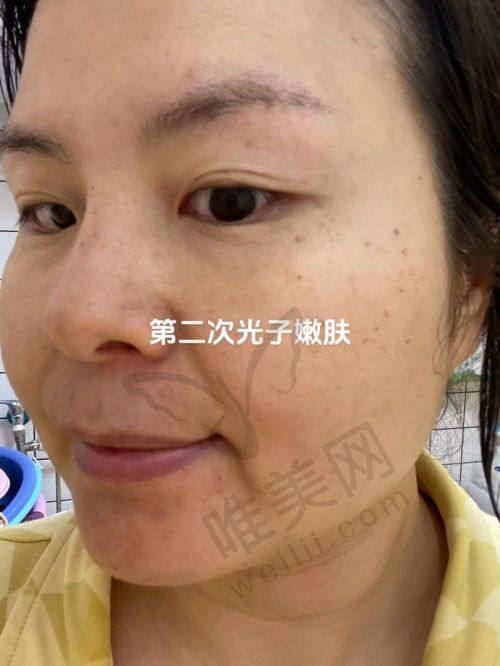 宁波光子嫩肤医院排名榜top5推荐