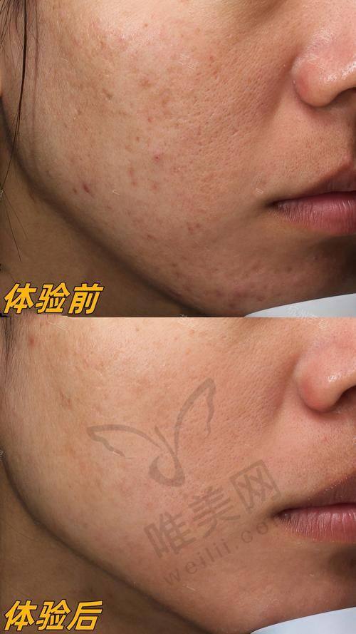 宁波光子嫩肤常见问题解答