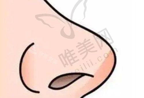 深圳注射隆鼻费用详情
