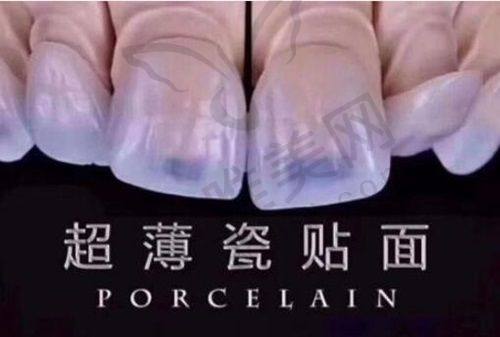 美国皓圣种植牙适用人群分析
