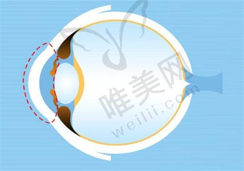 沧州爱尔眼科医院预约挂号方式