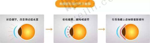 四、北京茗视光眼科医院全飞秒之手术优势：全方面出色体验