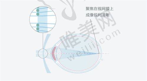 深圳华厦眼科医院：老花眼手术定制化服务佼佼者