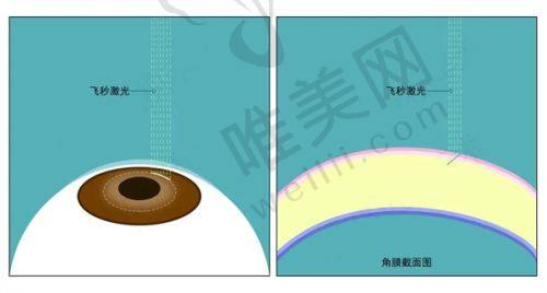 三、北京茗视光眼科医院全飞秒之手术前后感受与变化：告别困扰拥抱清晰