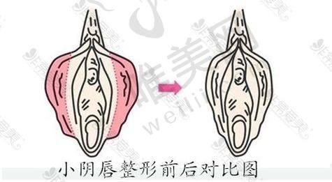 成都亨特医疗私密整形价格揭秘