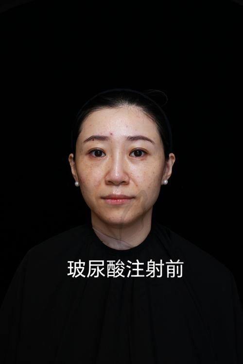上海玻尿酸注射性价比高的top8医院名单