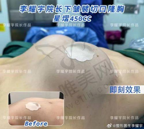 成都隆胸医生张雪峰傲诺拉星熠隆胸：价格透明到极致