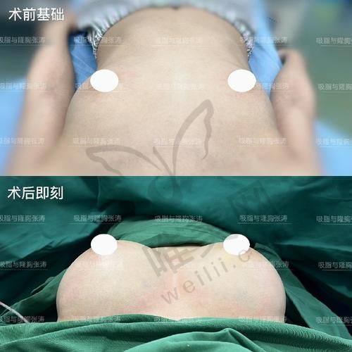 2025年成都张雪峰傲诺拉星熠隆胸面诊秘籍