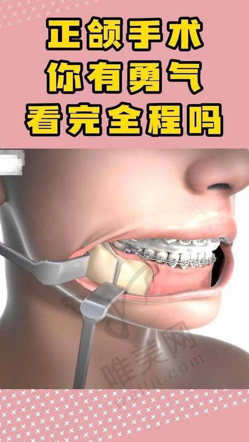 重庆肖林正颌费用解析