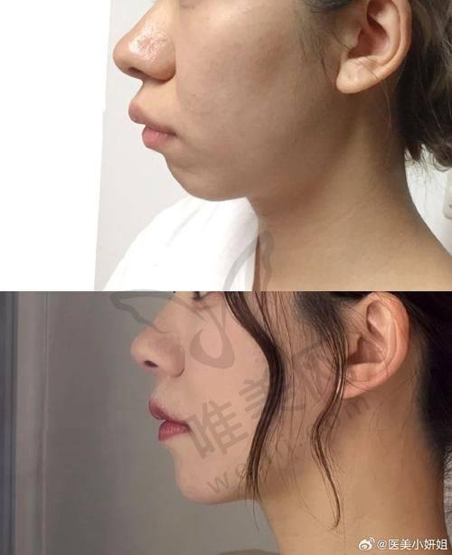肖林正颌手术患者实录