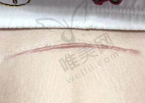 总结呼吁：深圳鹏程医院疤痕科值得信赖