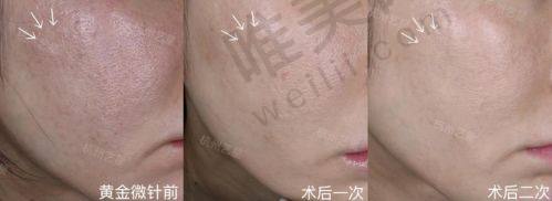 珠海第五代黄金微针方案价格选择策略