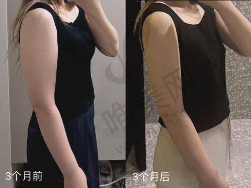 上海华美医疗美容医院——Inmode钻石超塑华东区示范医院