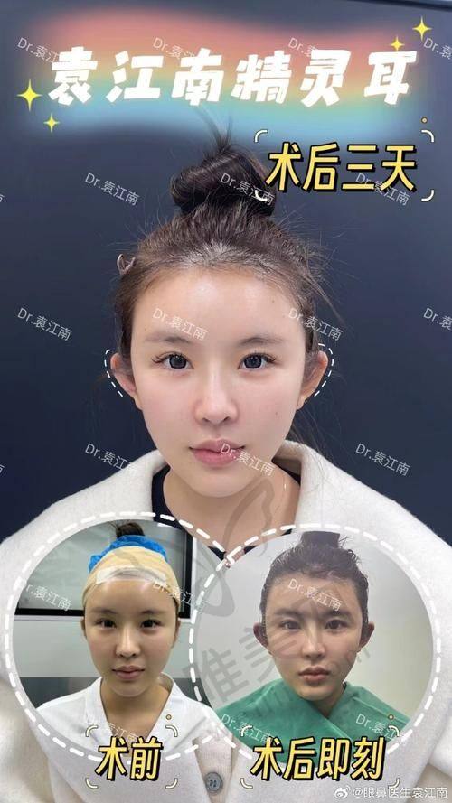 长沙精灵耳整形常见疑问快答