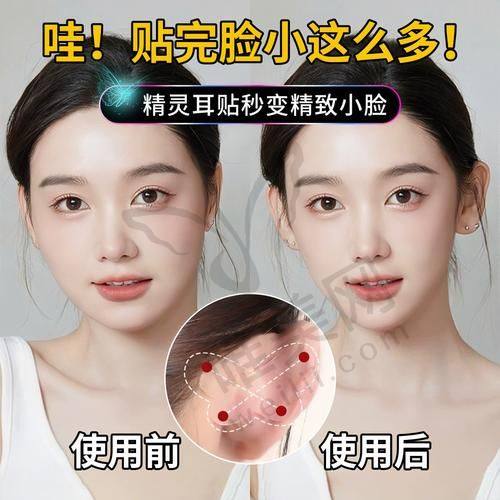 长沙精灵耳整形避坑指南