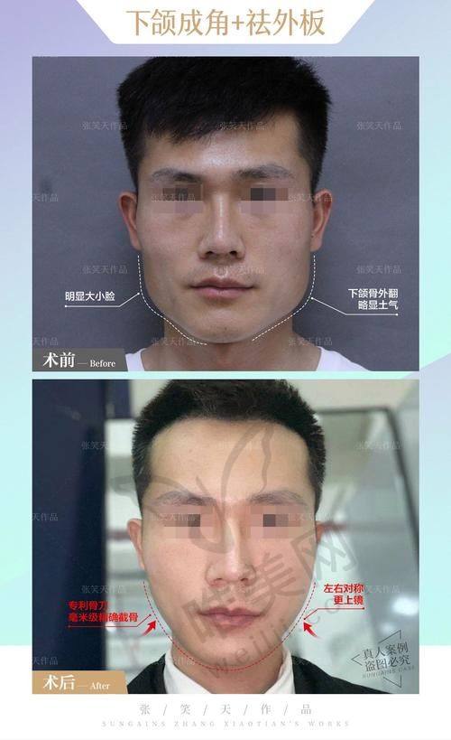 深圳罗奇磨骨是否靠谱