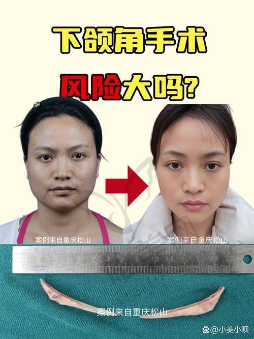 磨骨手术概述