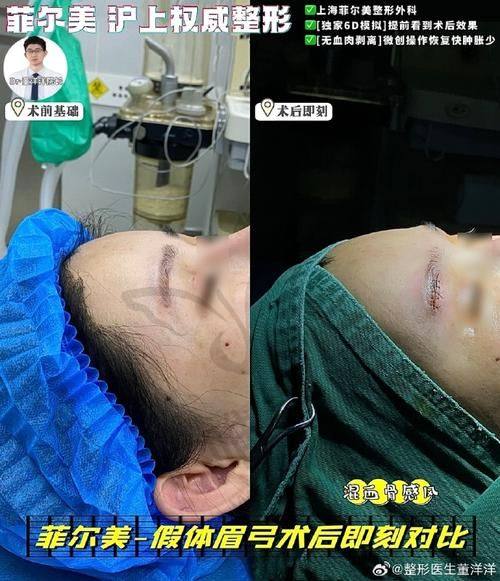 西安注射眉弓医生红榜