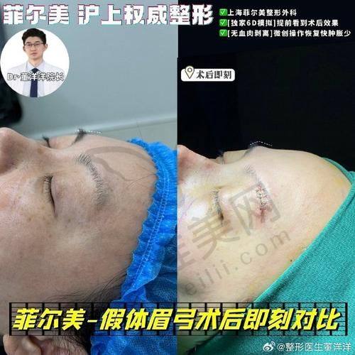 西安眉弓整形三大技术解析