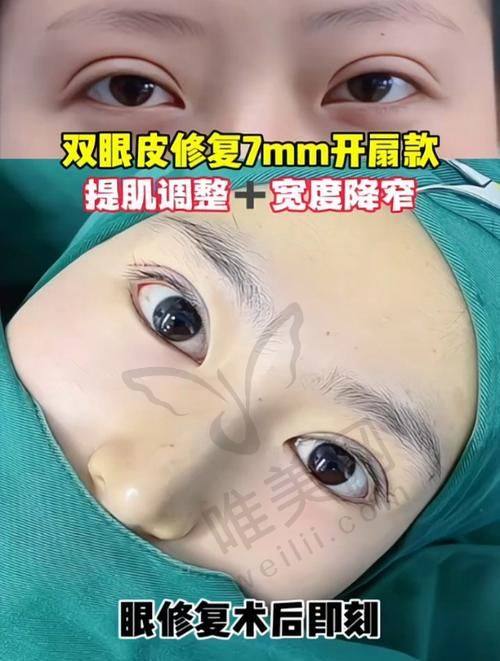 杜园园“黑科技”核心技术：引领双眼皮修复新潮流