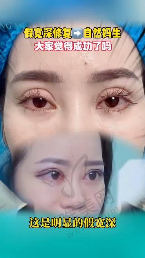 保命忠告：确保杜园园双眼皮修复顺利进行