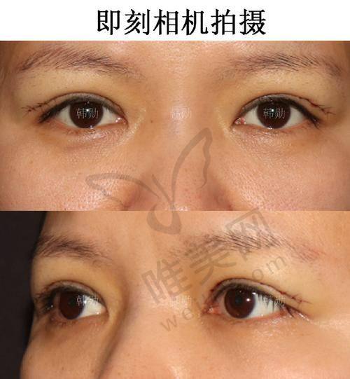 结尾总结：杜园园双眼皮修复助你实现美丽梦想