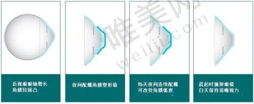 手术结果显著，患者满意度高：普瑞眼科近视眼手术带来清晰视力新改变