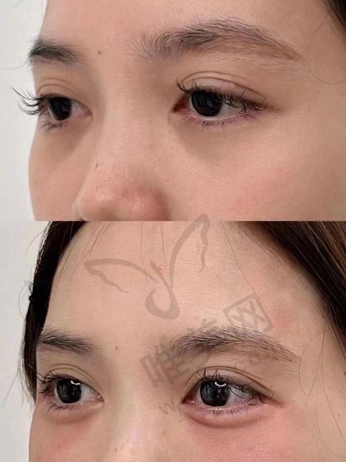 技术优势：打破传统的眼袋修复与卧蚕塑造技术