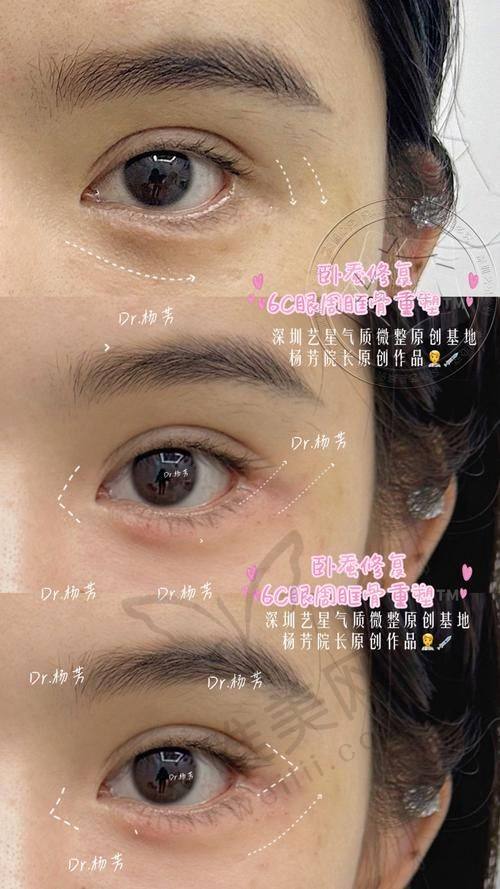 总结：值得信赖的眼袋修复与卧蚕塑造骨干医生王杨医生