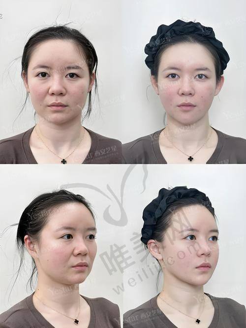 医生背景对比：黄罡、王阔远、李方奇各有所长，选对馒化脸修复医生是关键
