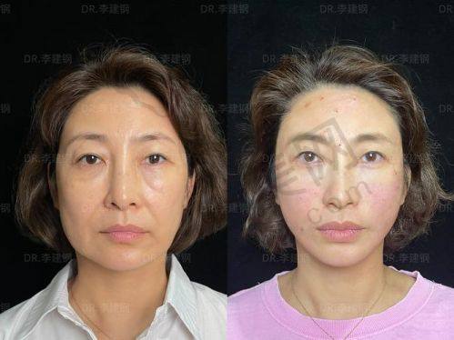 真实范例对比：黄罡、王阔远、李方奇实例说话，馒化脸修复成效看得见
