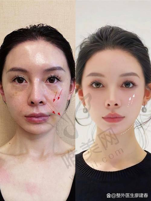 深圳阳光医院筋膜提升真人体验暴击