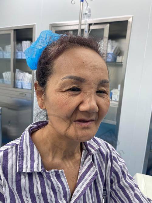 深圳阳光医院筋膜提升真心话分享实用