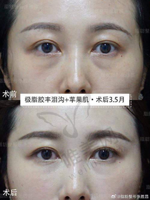一、爱贝芙填充塑形的魅力与维持时间