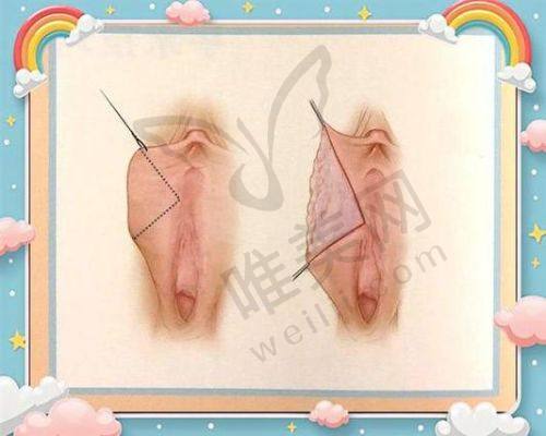 二、北京紧缩医院做的较好的医院之面部紧致项目
