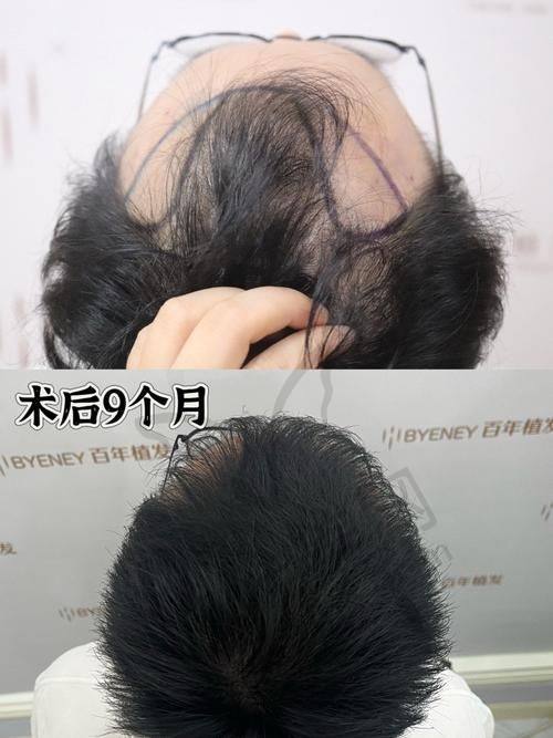 北京大麦微针植发医院优势