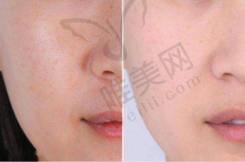 总结建议：理性选择东国水光针